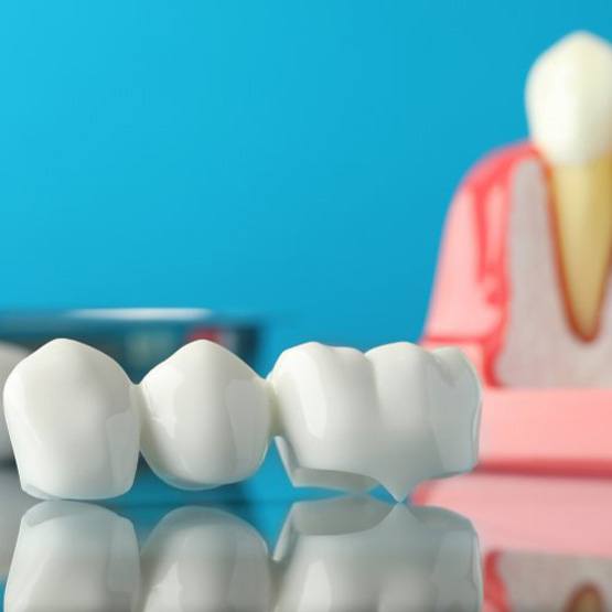 a model of dental bridges on a metal table