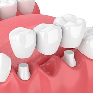 a 3D illustration of a traditional dental bridge