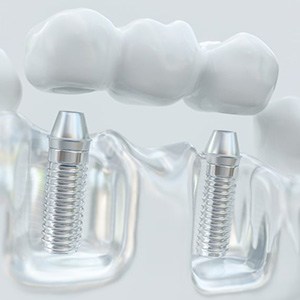 a 3D example of an implant dental bridge