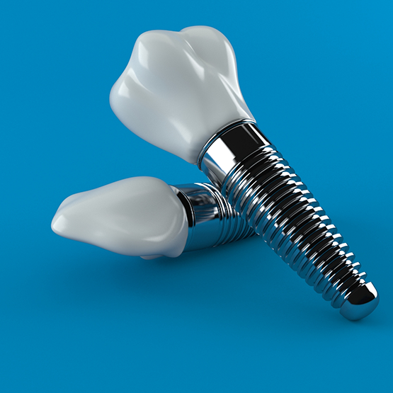 Model of two dental implants in Maplewood against a blue background
