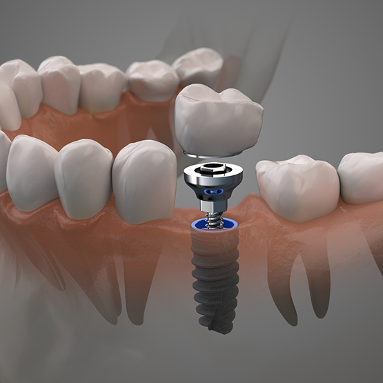 Illustration of a dental crown being fitted onto a dental implant in the lower jaw