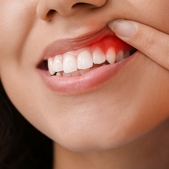 Person pointing to a red spot in their gums before gum disease treatment