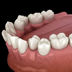 Illustration of crowded teeth