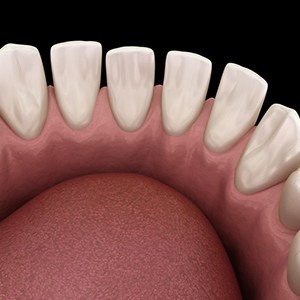 Illustration of teeth with gaps