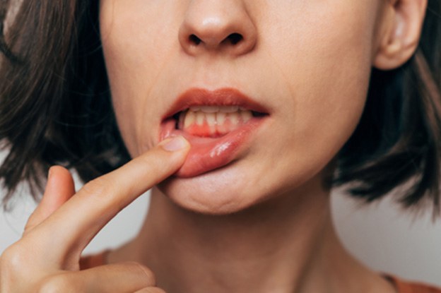 Woman pulling lip down to reveal red, swollen gums