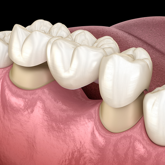 Illustration of a dental bridge being placed to replace a missing tooth