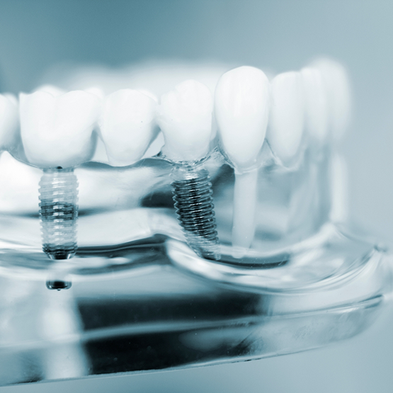Model of the mouth with two dental implants replacing missing teeth