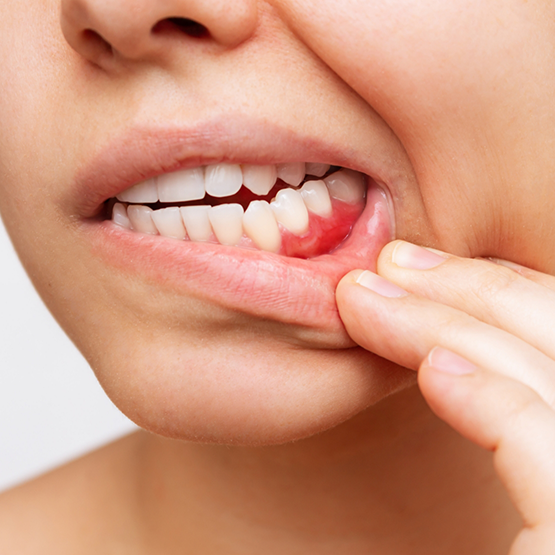 Close up of a person with red gums