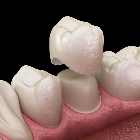 Illustration of a dental crown being placed over a tooth