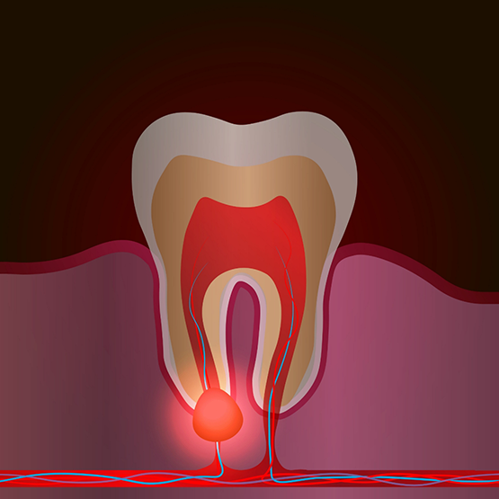 Illustration of an infected tooth needing root canal treatment