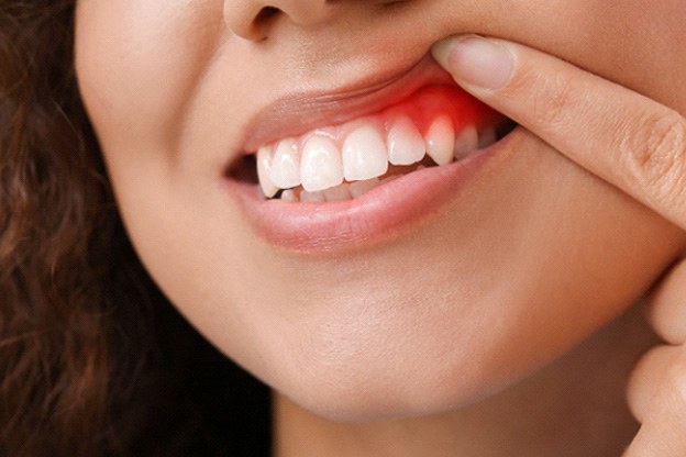 Woman placing Invisalign over upper arch