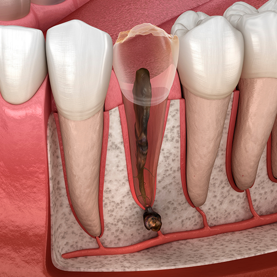 Illustration of a severely damaged tooth that needs a tooth extraction in Maplewood
