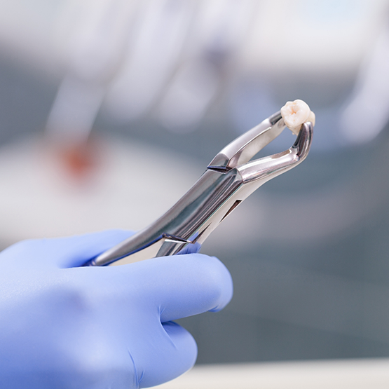 Dentist holding an extracted tooth in a clasp