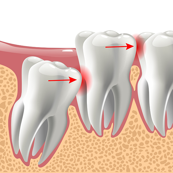 Illustration of an impacted wisdom tooth pressing against the adjacent tooth